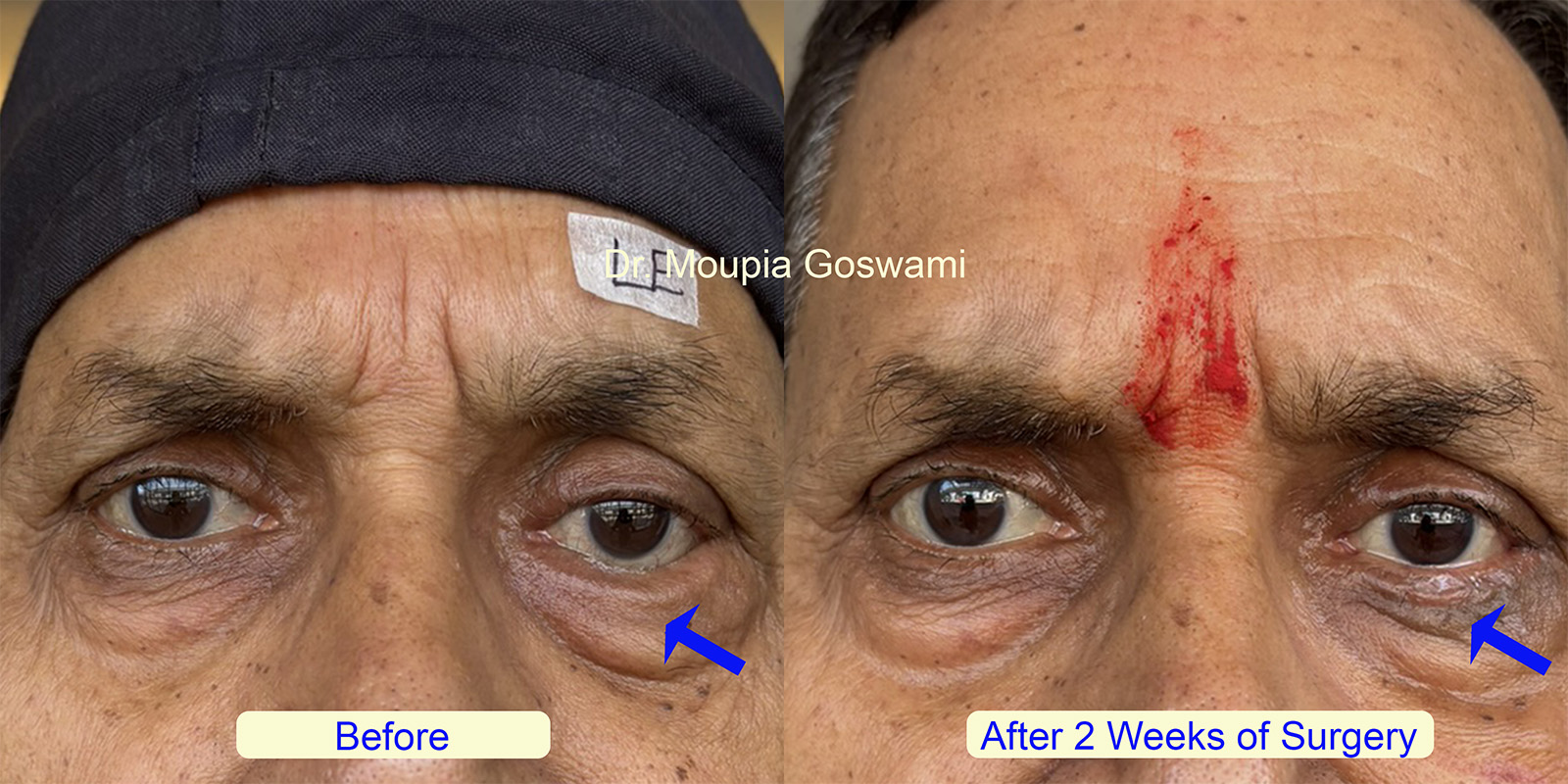 Entropion Surgery Before and After - Case 5